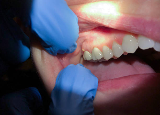 Emergency Dental Filling Replacement in GA